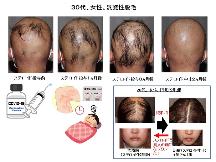 円形脱毛症　病院